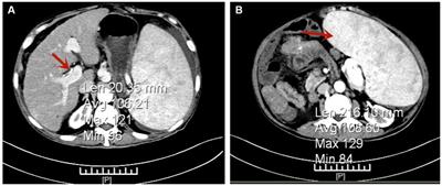 Case report: Primary myelofibrosis presenting with portal hypertension mimicking cirrhosis